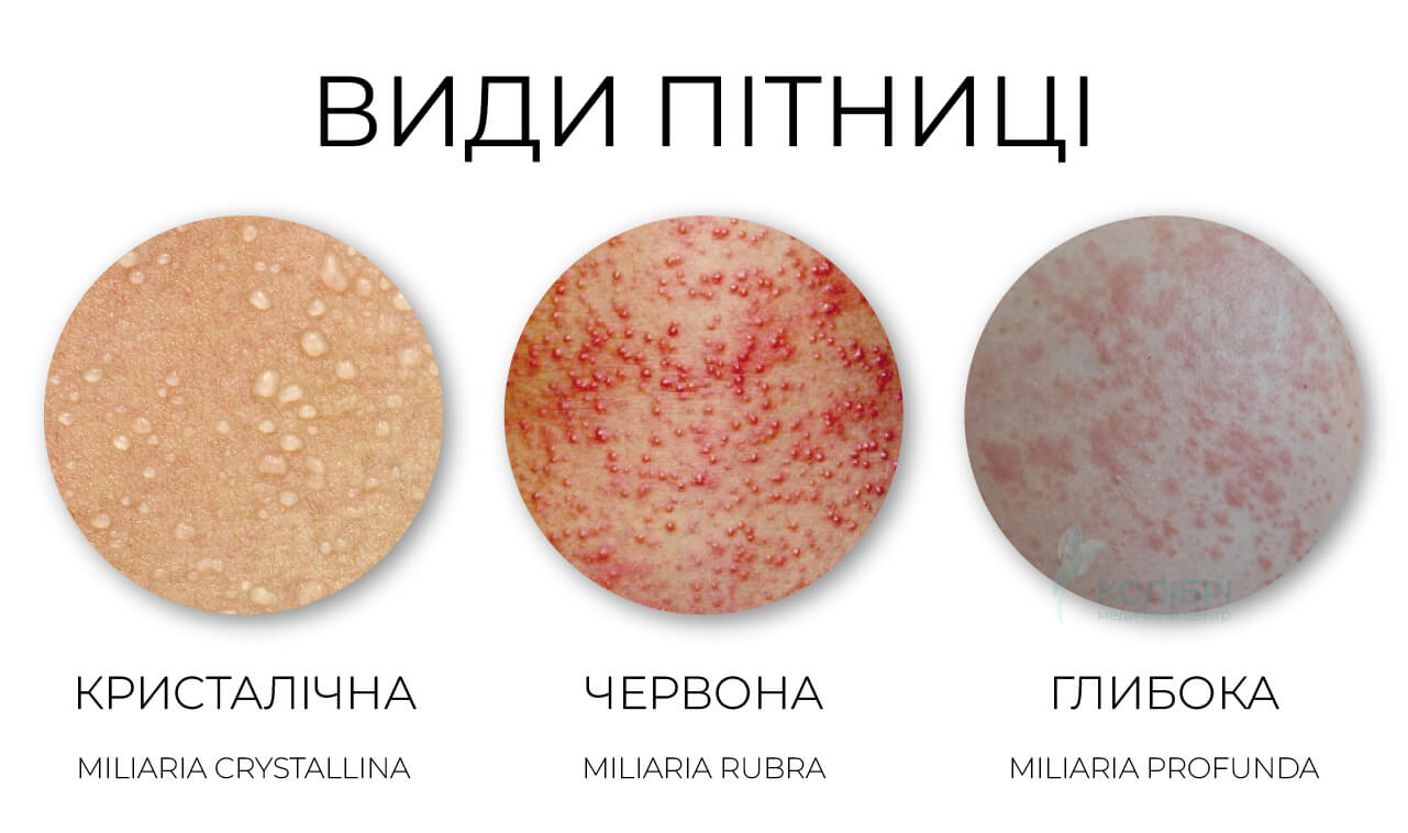 Фото пітниці у дорослих, пітниця у дітей фотографії, як виглядає пітниця: кристалічна, червона, глибока.