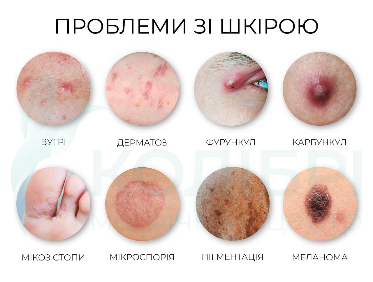 Проблеми зі шкірою фотографії, мікоз стоп фото, мікроспорія фото, пігментація фото, меланома фото, як виглядають: вугрі, дерматози, фурункули, карбункули.